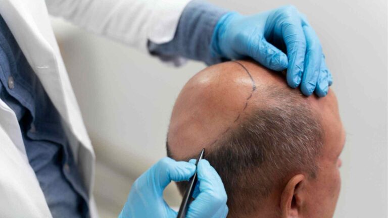 Hair transplant procedure