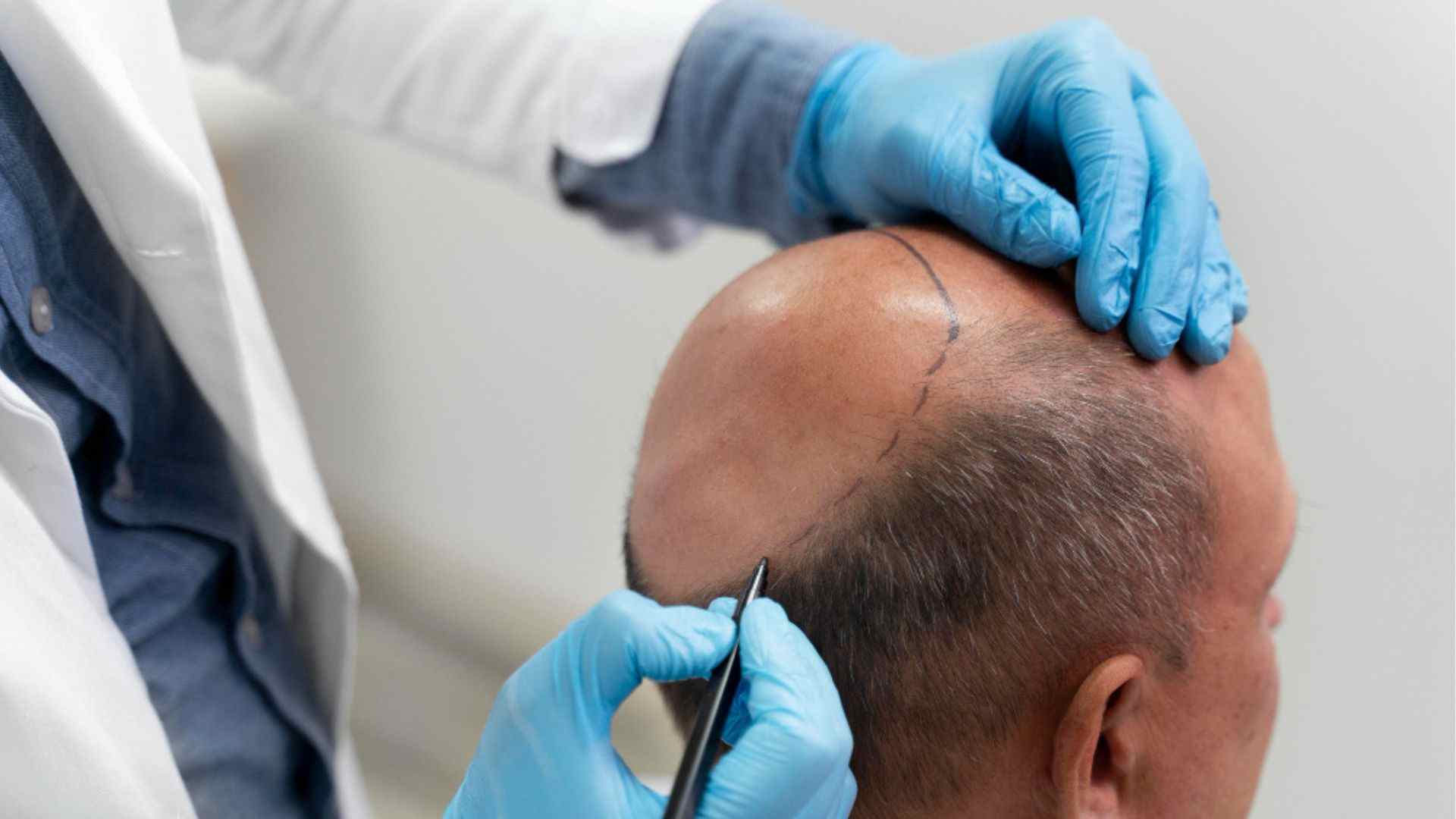 Ultimate Guide to Hair Transplant Procedure – Everything You Need to Know