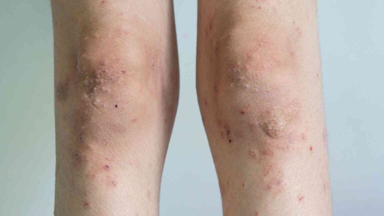 Causes of Hidradenitis Suppurativa