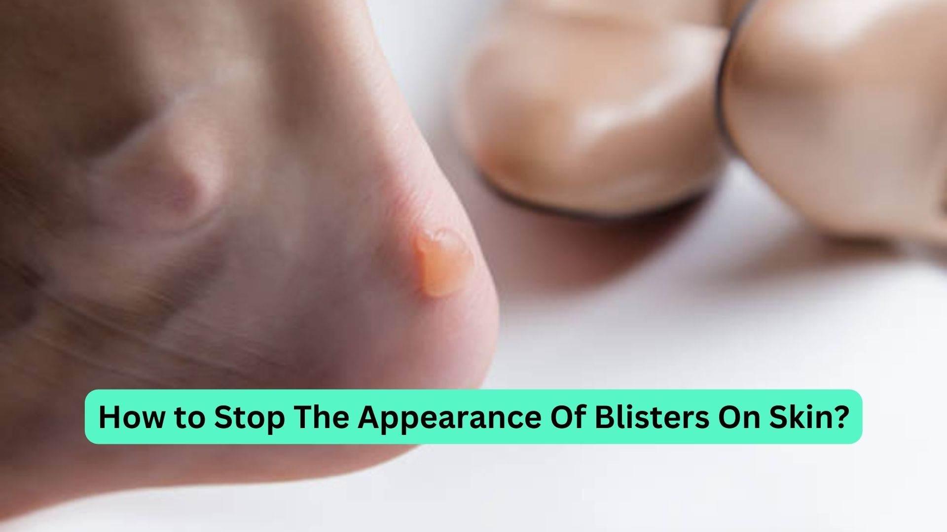 How to Stop the Appearance of Blisters On Skin