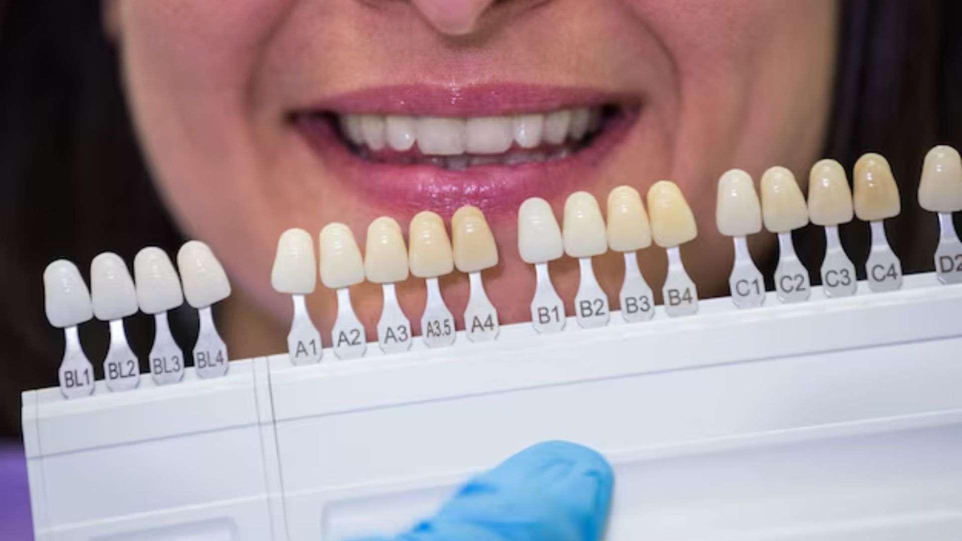 What are the factors that affect the cost of tooth bonding?