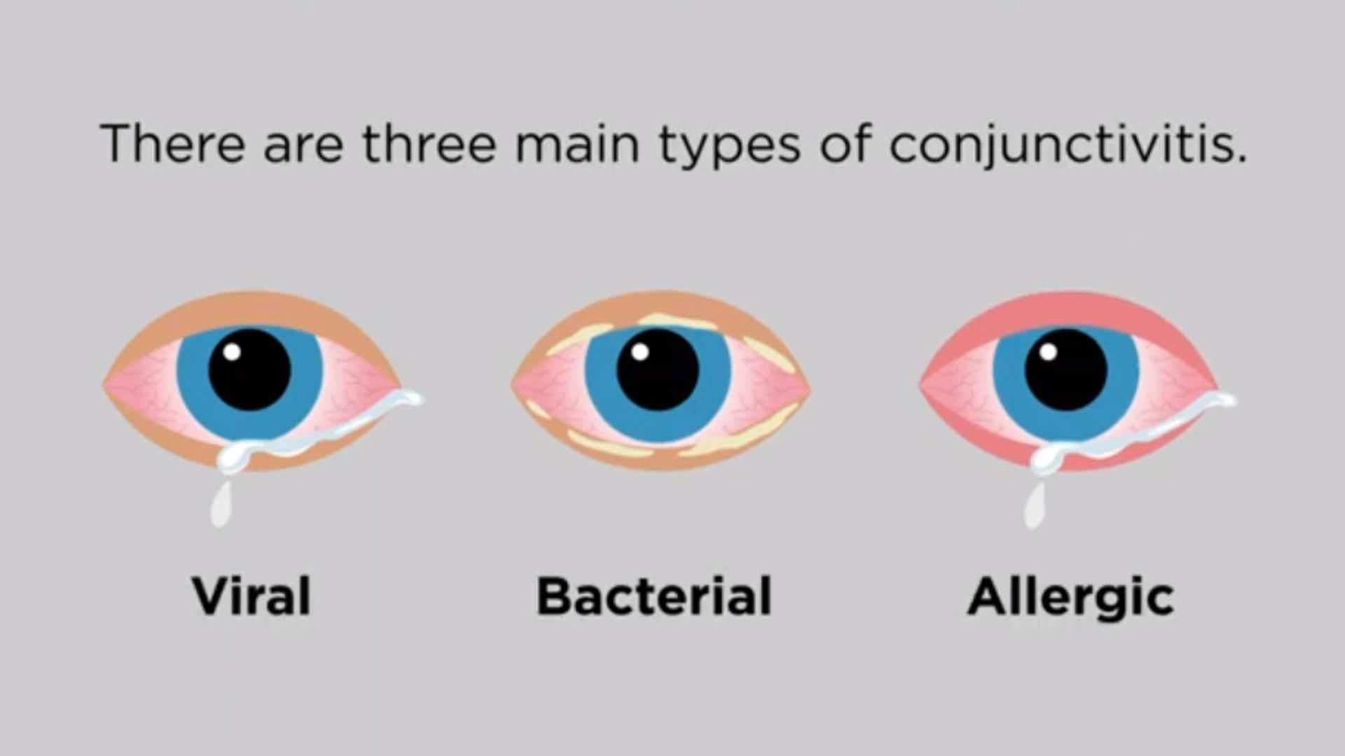 What are the main Types of Conjunctivitis?